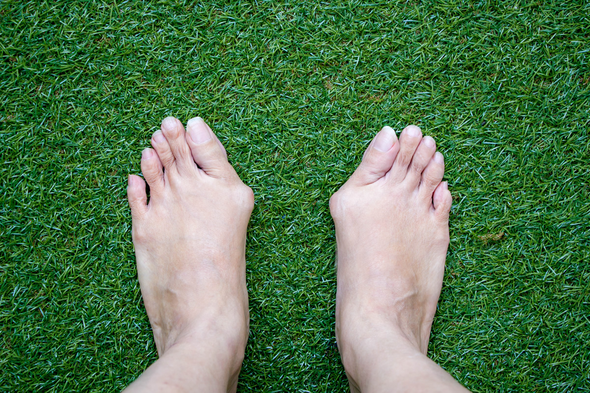 Deformacje stopy — rodzaje, zapobieganie, leczenie