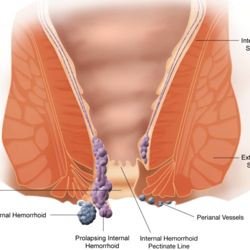 Hemoroidy. operacja hemoroidów metodą Lockhart-Mummery