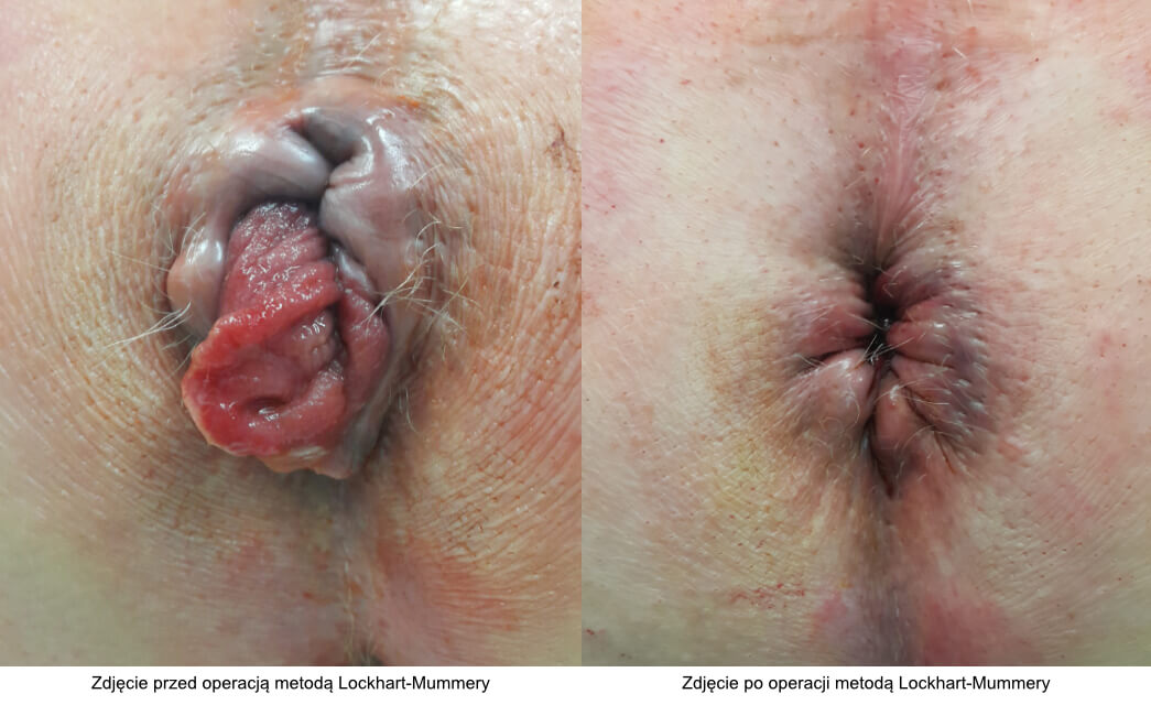 Operacja hemoroidów metodą Lockhart-Mummery - zdjęcia przed i po
