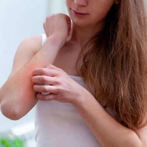 Młoda kobieta drapie się po ręce. Testy alergiczne - kiedy najlepiej zaplanować wizytę u alergologa