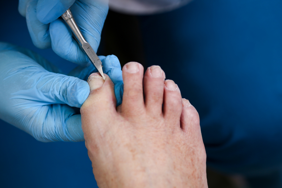 Lekarz wycina wrastający paznokieć - Choroby stóp - o czym może świadczyć ból, swędzenie lub obrzęk?