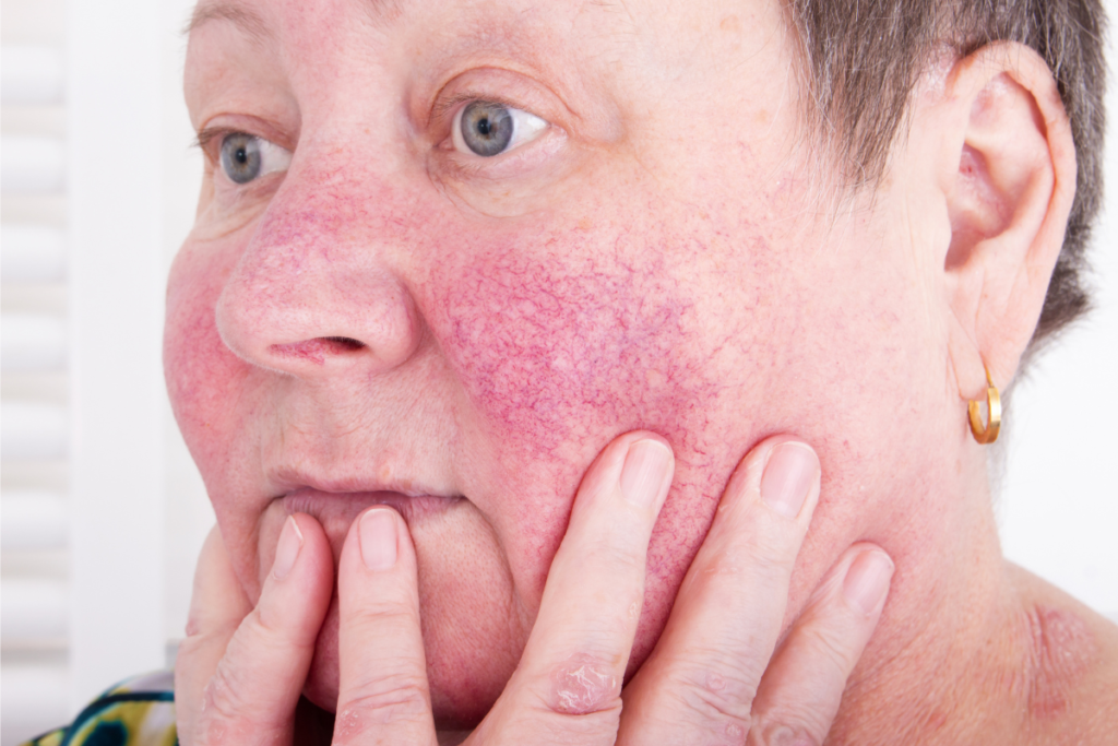 Kobieta z objawami trądziku różowatego na twarzy - leczenie trądziku różowatego