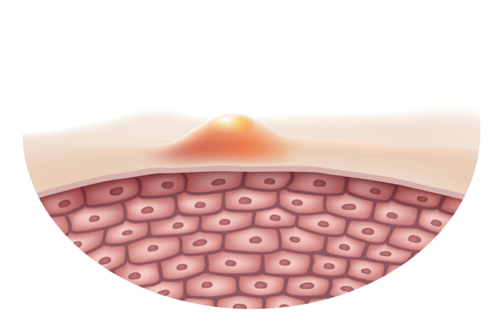 Przekrój skóry - leczenie trądziku różowatego