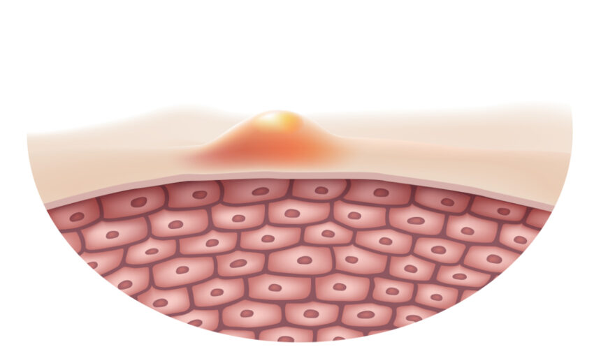 Przekrój skóry - leczenie trądziku różowatego