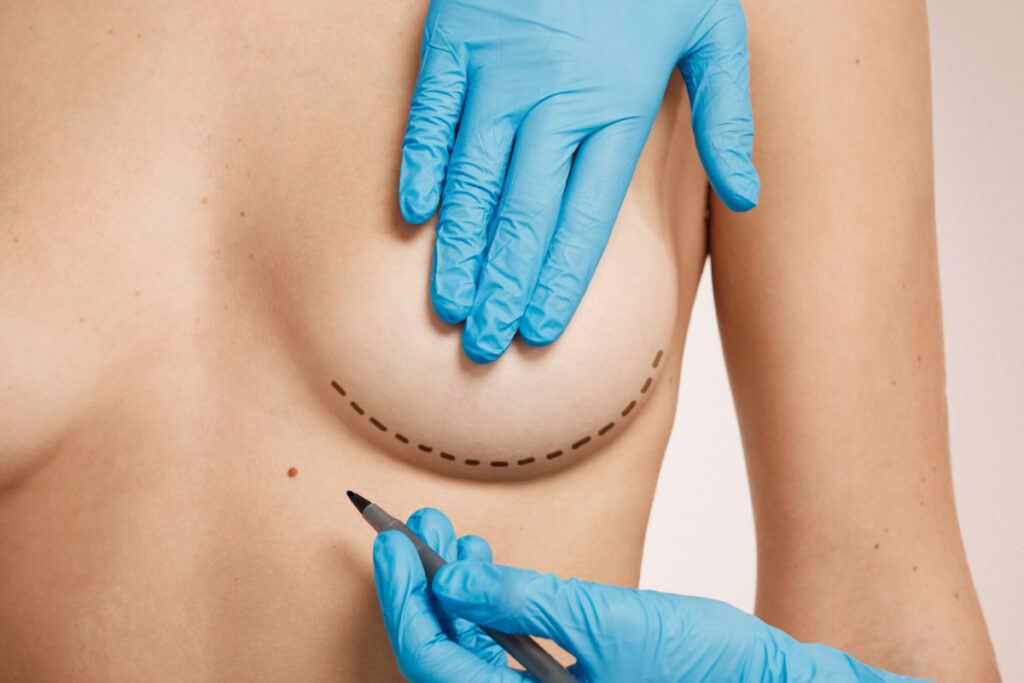 Kobieta przed operacją powiększenia piersi. operacje plastyczne katowice