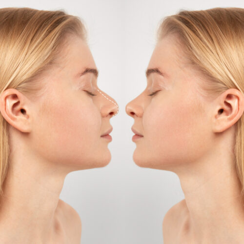 Korekta nosa. Kobieta przed i po zabiegu. Operacje plastyczne katowice
