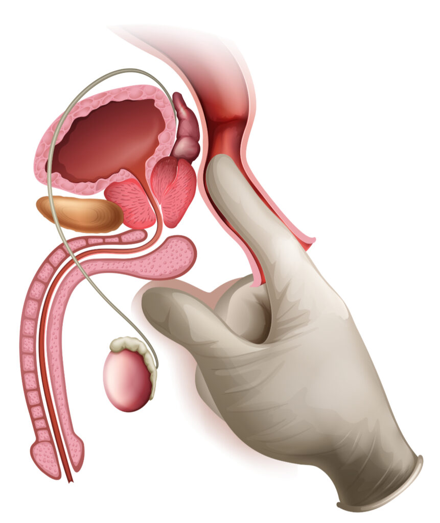 Badanie per rectum - Profilaktyka raka prostaty
