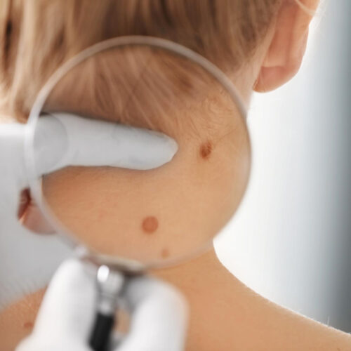 Dermatolog diagnozuje zmiany barwnikowe na skórze. Nowoczesna dermatologia.