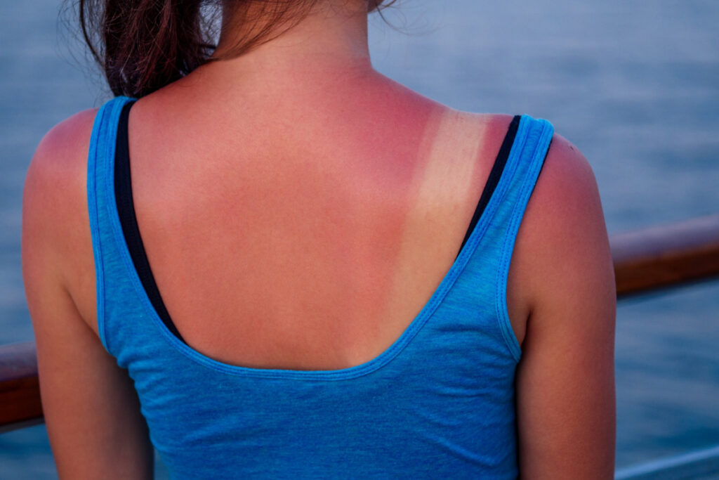 Mocna opalenizna na plecach młodej kobiety. Poparzenia słoneczne — domowe sposoby na ich opatrywanie