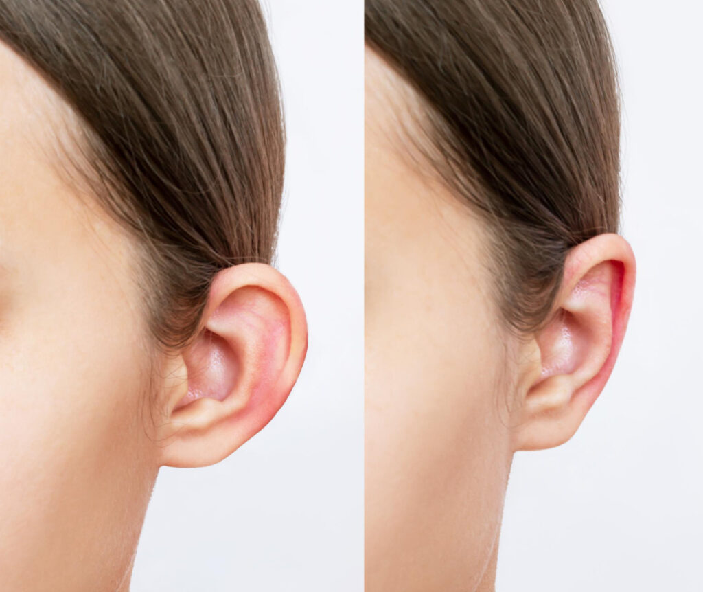 Korekcja uszu — efekt przed i po