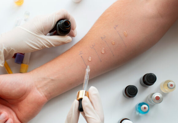 Skórne testy alergiczne. Jaka powinna być częstość testów alergicznych