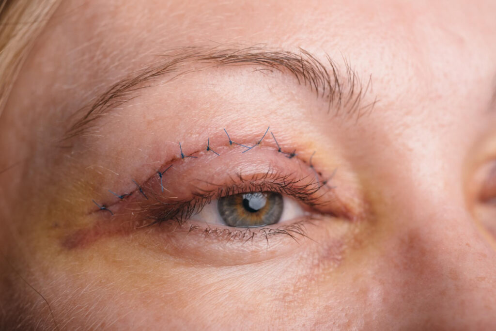 Oko powieki po zabiegu blefaroplastyki