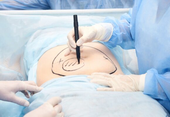 Chirurg zaznacza na brzuchu miejsce zabiegu - Czy liposukcja jest zabiegiem bezpiecznym