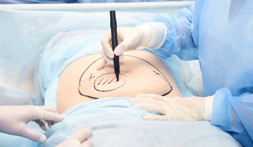Chirurg zaznacza na brzuchu miejsce zabiegu - Czy liposukcja jest zabiegiem bezpiecznym