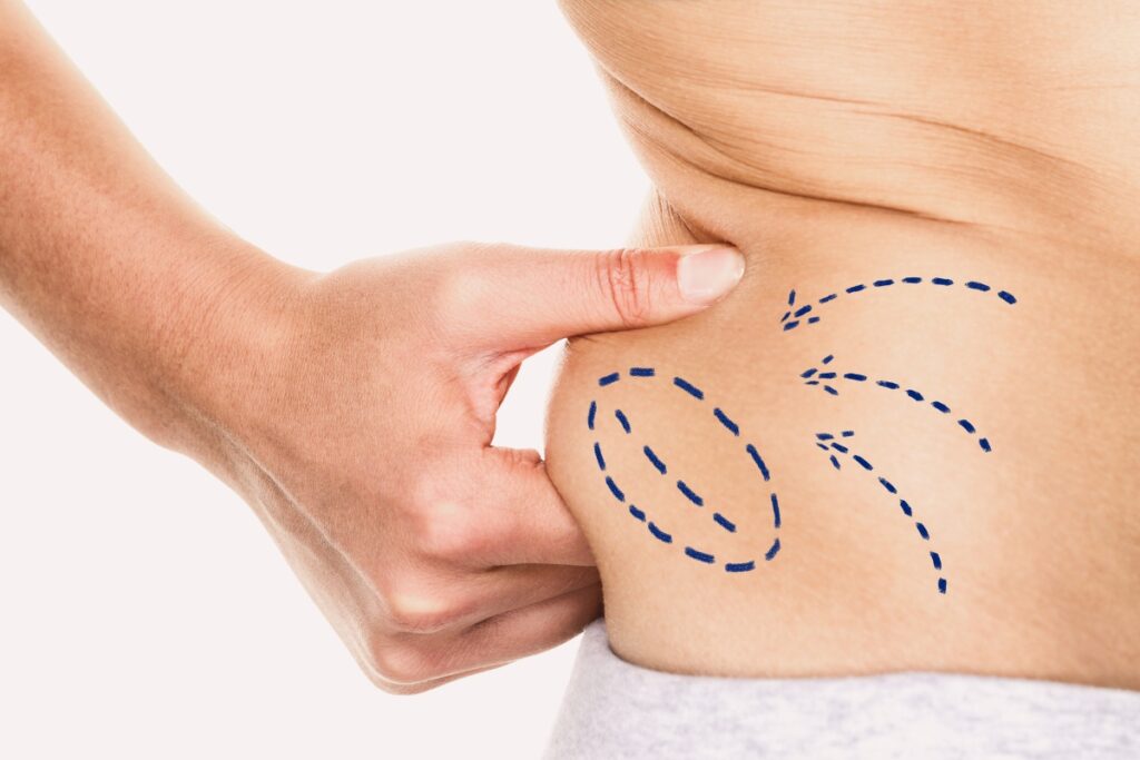 Oznaczenie miejsc przed zabiegiem liposukcji