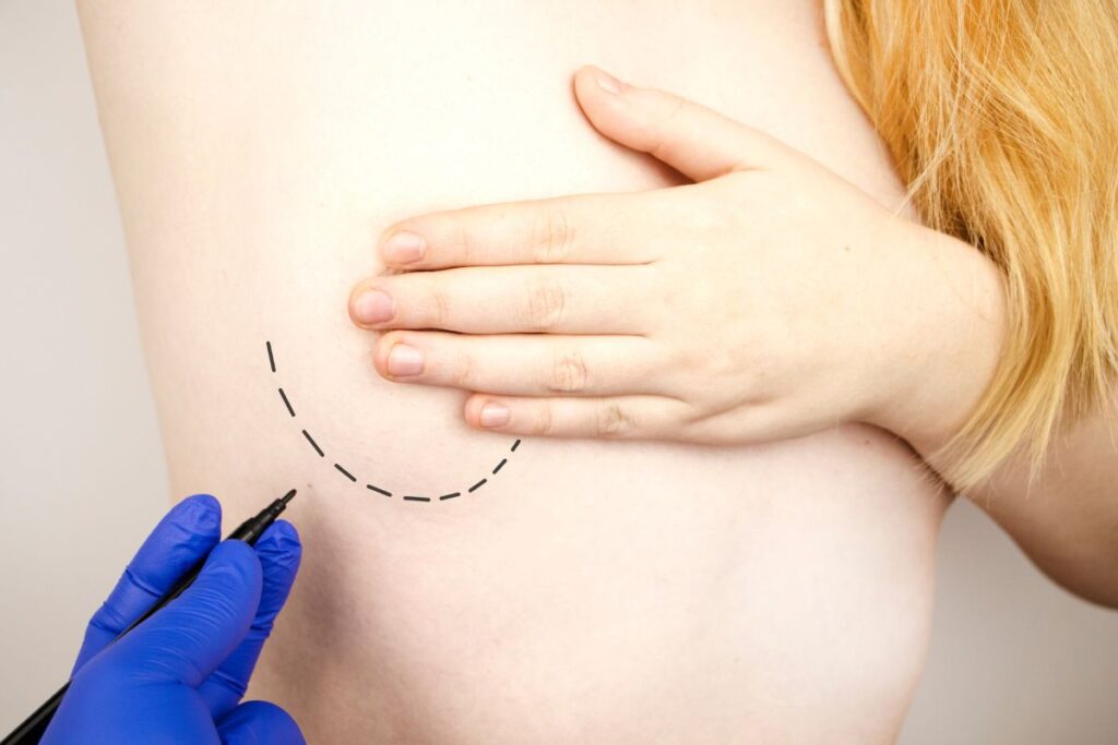 Zaznaczenie cięcia przed operacją plastyczną piersi