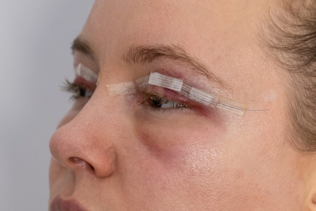 Kobieta po zabiegu blefaroplastyki z opatrunkami na powiekach