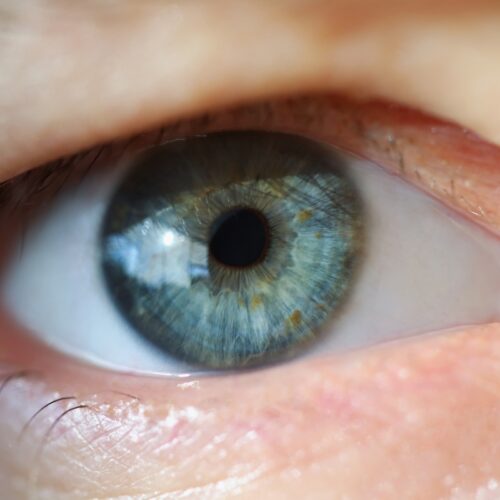 Oko z opadającą powieką - zabieg blefaroplastyki
